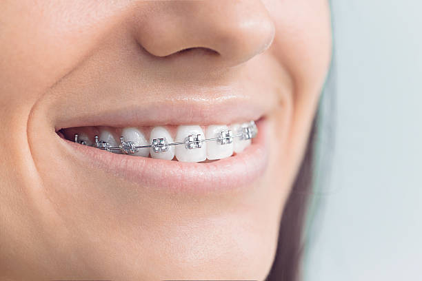 Dental Bonding in Budd Lake, NJ